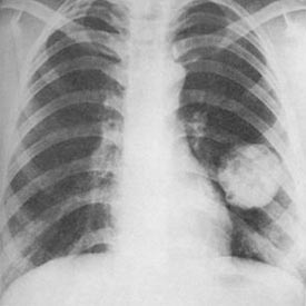 肺部有阴影是怎么回事?
